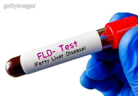 fib 4 blood test bottle|labcorp fib 4.